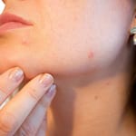 dermal filling