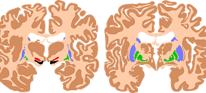 Cerebral Palsy