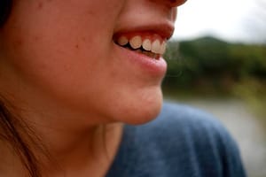 acne removal