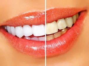 whitener teeth 