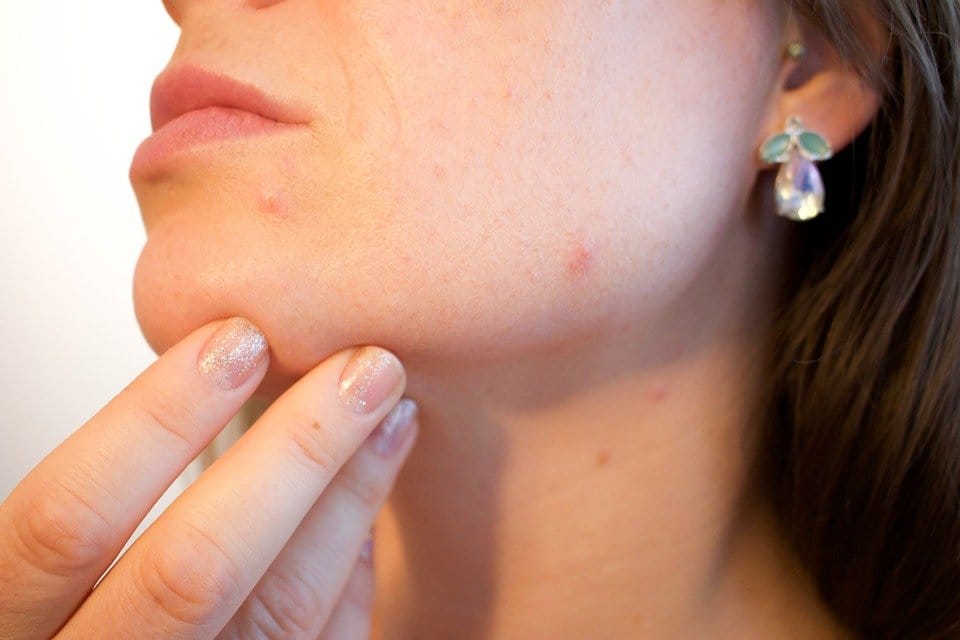 A Review of the Best Acne Scar Treatment  Methods